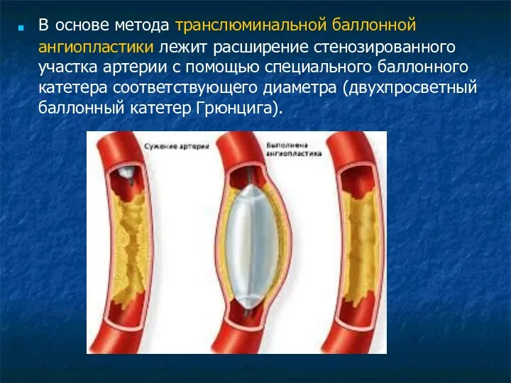В основе метода транслюминальной баллонной ангиопласти­ки лежит расширение стенозированного участка