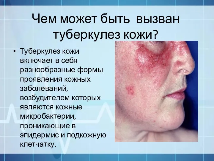 Чем может быть вызван туберкулез кожи? Туберкулез кожи включает в