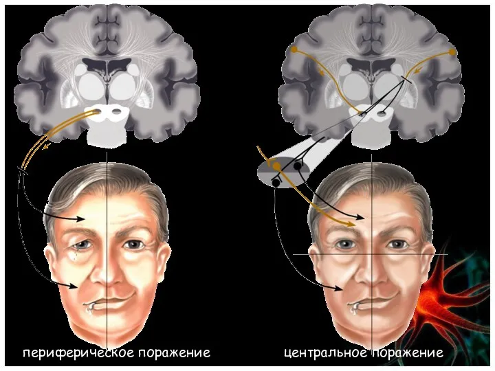 периферическое поражение центральное поражение