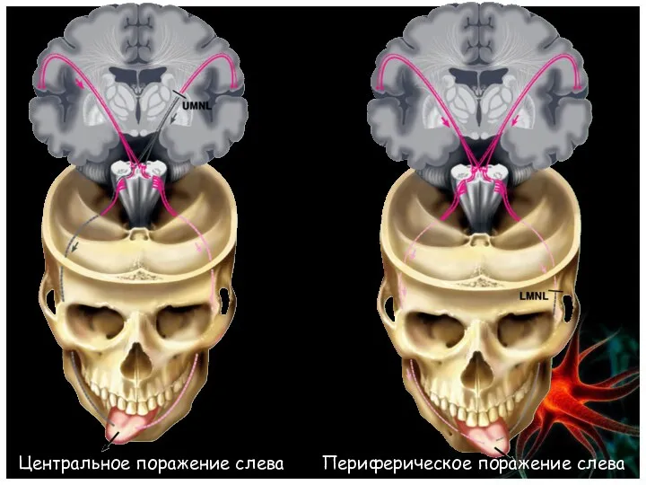 Центральное поражение слева Периферическое поражение слева