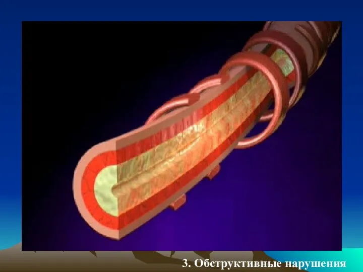 3. Обструктивные нарушения