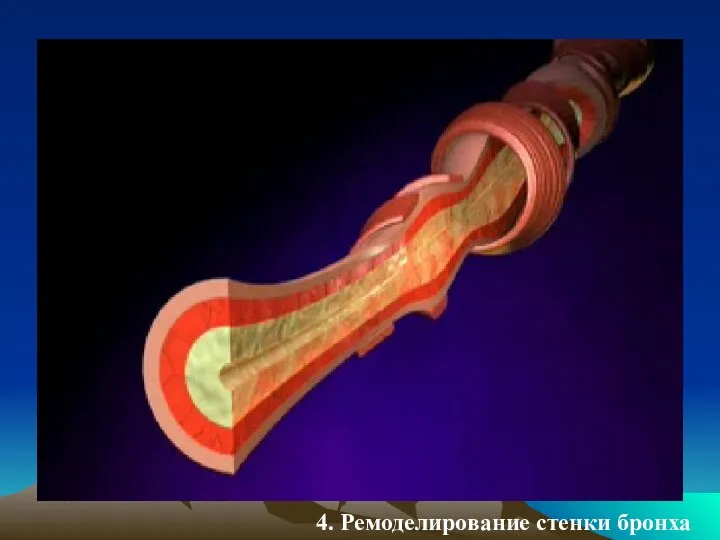 4. Ремоделирование стенки бронха