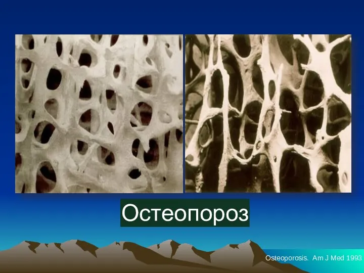 Остеопороз Osteoporosis. Am J Med 1993