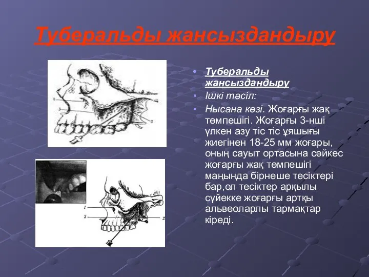 Туберальды жансыздандыру Туберальды жансыздандыру Ішкі тәсіл: Нысана көзі. Жоғарғы жақ