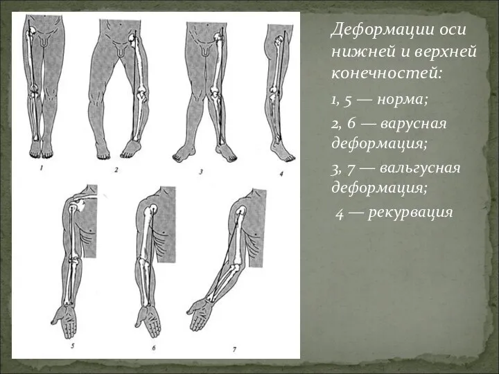 Деформации оси нижней и верхней конечностей: 1, 5 — норма;