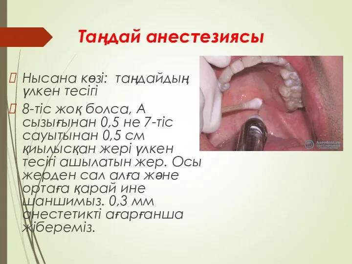 Таңдай анестезиясы Нысана көзі: таңдайдың үлкен тесігі 8-тіс жоқ болса,