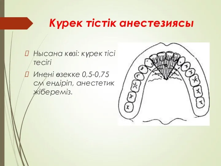 Күрек тістік анестезиясы Нысана көзі: күрек тісі тесігі Инені өзекке 0,5-0,75 см ендіріп, анестетик жібереміз.