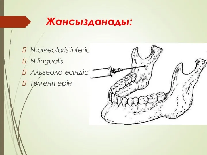 Жансызданады: N.alveolaris inferior N.lingualis Альвеола өсіндісі Төменгі ерін