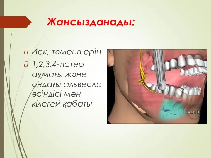 Жансызданады: Иек, төменгі ерін 1,2,3,4-тістер аумағы және ондағы альвеола өсіндісі мен кілегей қабаты