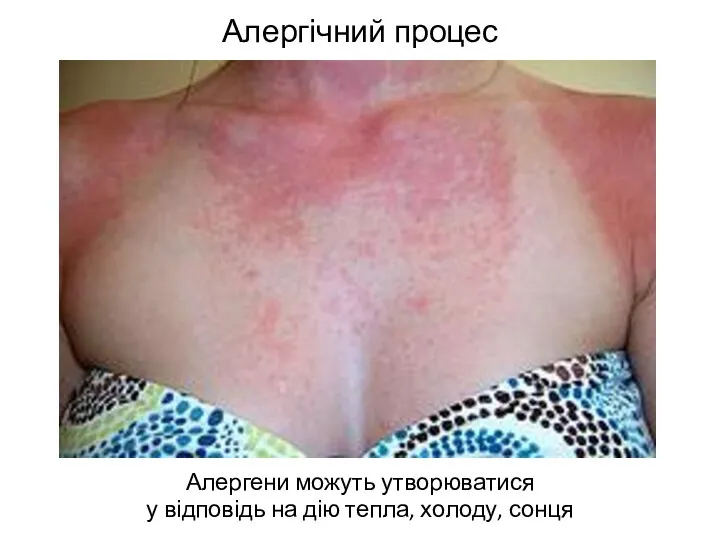 Алергічний процес Алергени можуть утворюватися у відповідь на дію тепла, холоду, сонця