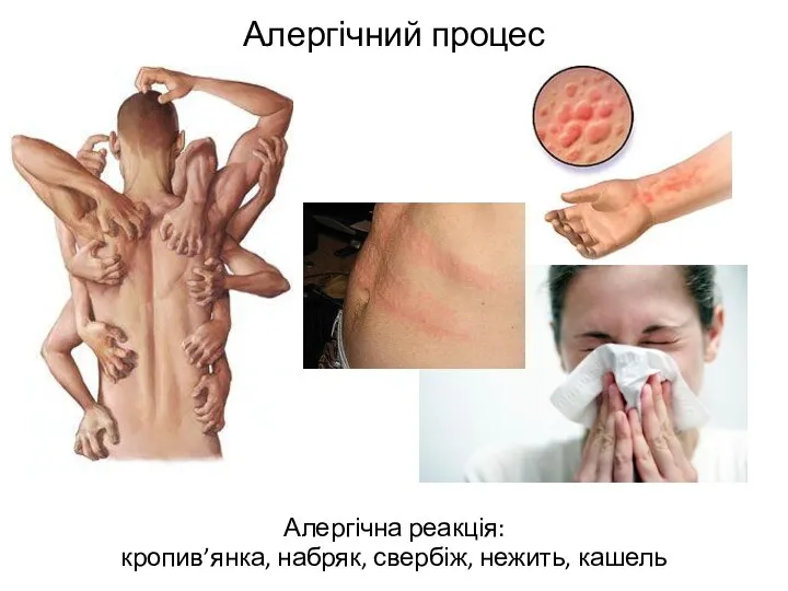 Алергічний процес Алергічна реакція: кропив’янка, набряк, свербіж, нежить, кашель