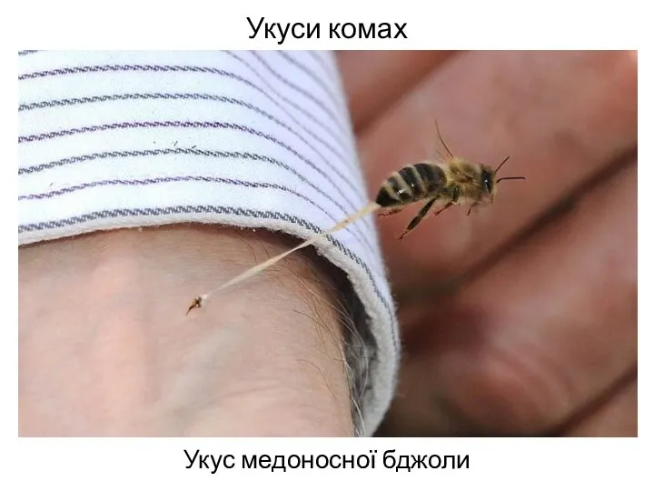 Укуси комах Укус медоносної бджоли