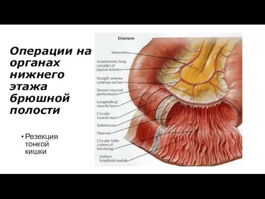 Операции на органах нижнего этажа брюшной полости Резекция тонкой кишки