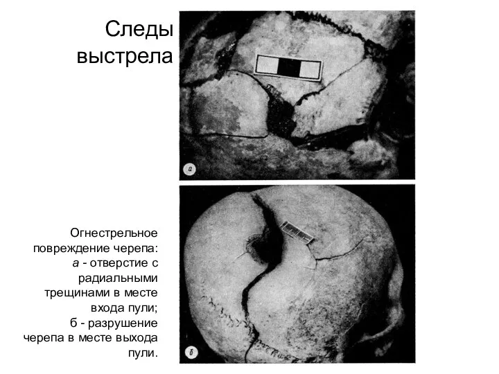 Следы выстрела Огнестрельное повреждение черепа: а - отверстие с радиальными