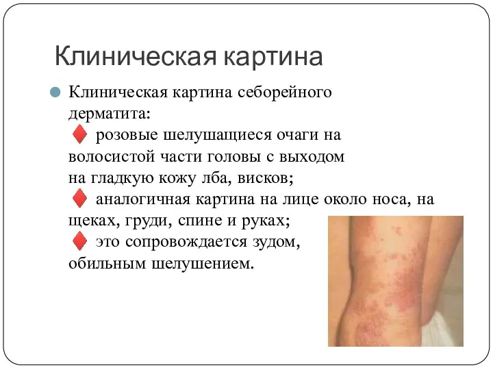 Клиническая картина Клиническая картина себорейного дерматита: ♦ розовые шелушащиеся очаги