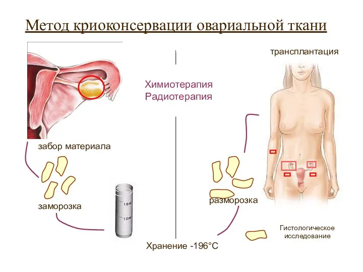 Метод криоконсервации овариальной ткани Гистологическое исследование