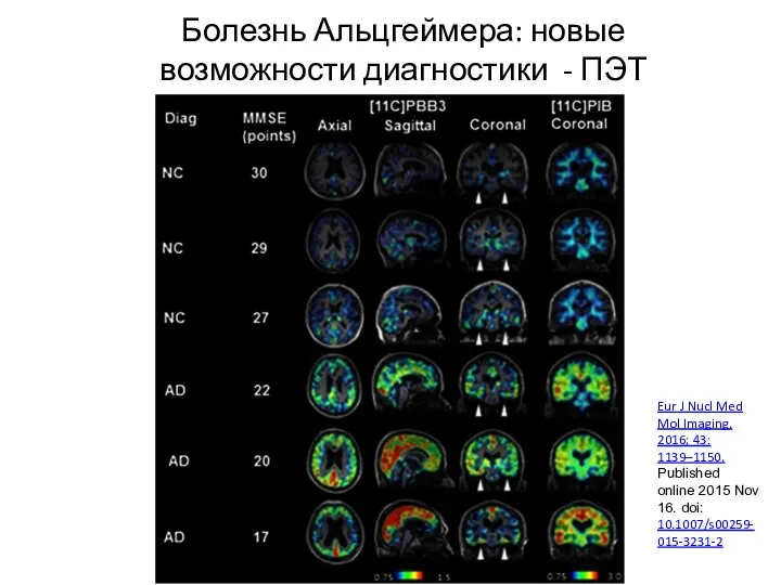 Болезнь Альцгеймера: новые возможности диагностики - ПЭТ Eur J Nucl