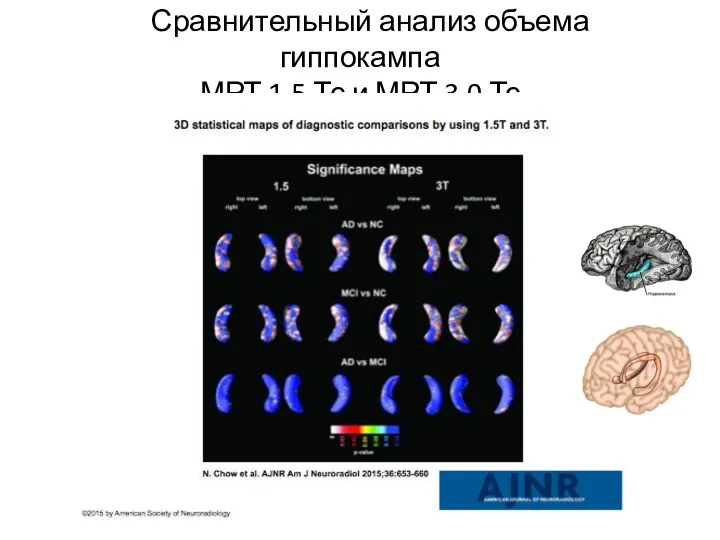 Сравнительный анализ объема гиппокампа МРТ 1.5 Тс и МРТ 3.0 Тс