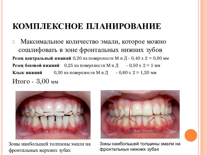 КОМПЛЕКСНОЕ ПЛАНИРОВАНИЕ Максимальное количество эмали, которое можно сошлифовать в зоне фронтальных нижних зубов