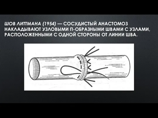 ШОВ ЛИТТМАНА (1954) — СОСУДИСТЫЙ АНАСТОМОЗ НАКЛАДЫВАЮТ УЗЛОВЫМИ П-ОБРАЗНЫМИ ШВАМИ С УЗЛАМИ, РАСПОЛОЖЕННЫМИ