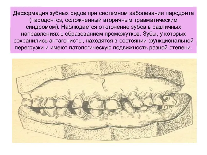 Деформация зубных рядов при системном заболевании пародонта (пародонтоз, осложненный вторичным травматическим синдромом). Наблюдается