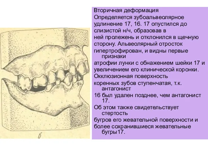 Вторичная деформация Определяется зубоальвеолярное удлинение 17, 16. 17 опустился до слизистой н/ч, образовав