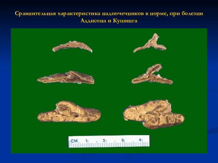 Сравнительная характеристика надпочечников в норме, при болезни Аддисона и Кушинга