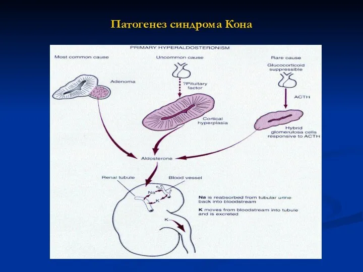 Патогенез синдрома Кона