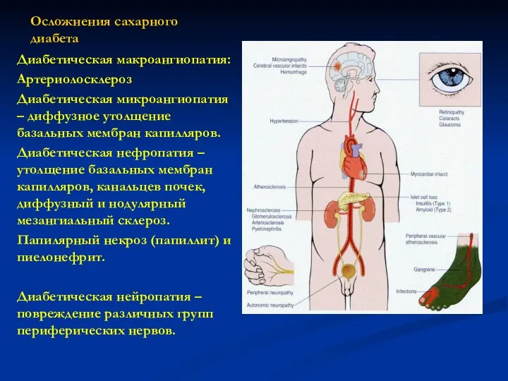 Осложнения сахарного диабета Диабетическая макроангиопатия: Артериолосклероз Диабетическая микроангиопатия – диффузное