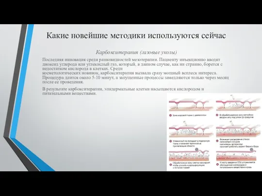 Какие новейшие методики используются сейчас Карбокситерапия (газовые уколы) Последняя инновация