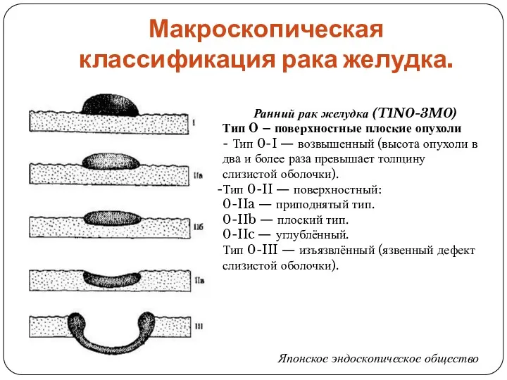 Макроскопическая классификация рака желудка. Ранний рак желудка (T1N0-3M0) Тип 0