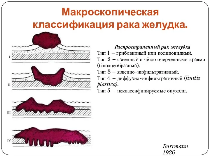 Макроскопическая классификация рака желудка. Распространенный рак желудка Тип 1 –