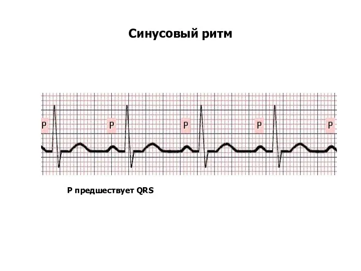 Синусовый ритм Р предшествует QRS