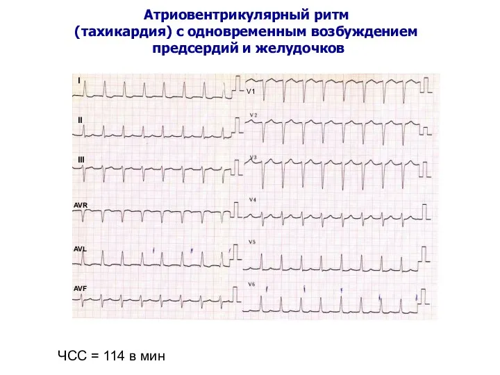 Атриовентрикулярный ритм (тахикардия) с одновременным возбуждением предсердий и желудочков ЧСС