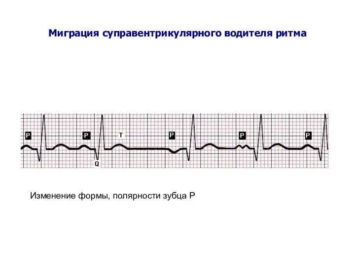 Миграция суправентрикулярного водителя ритма Изменение формы, полярности зубца Р