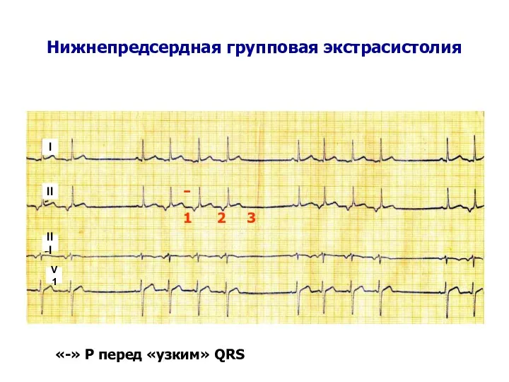 Нижнепредсердная групповая экстрасистолия - «-» Р перед «узким» QRS 1 2 3 I II III V1