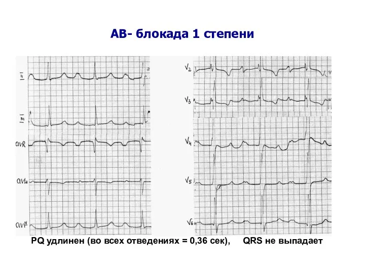 АВ- блокада 1 степени PQ удлинен (во всех отведениях = 0,36 сек), QRS не выпадает