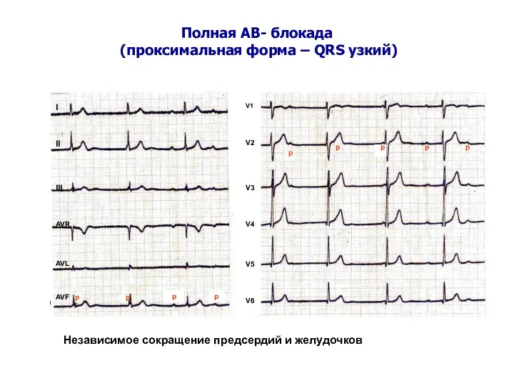 Полная АВ- блокада (проксимальная форма – QRS узкий) I II