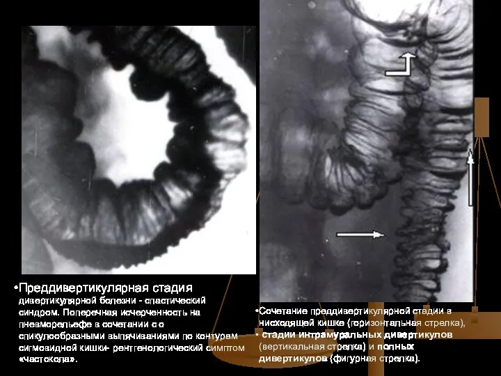 Преддивертикулярная стадия дивертикулярной болезни - спастический синдром. Поперечная исчерченность на