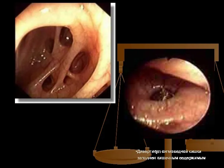 Дивертикул сигмовидной кишки заполнен кишечным содержимым