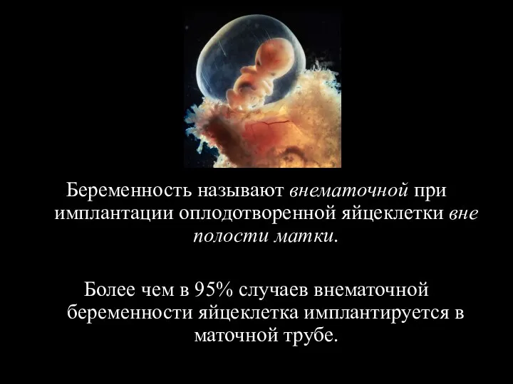 Беременность называют внематочной при имплантации оплодотворенной яйцеклетки вне полости матки.