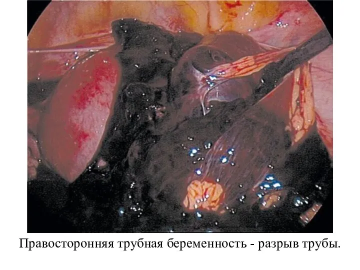 Правосторонняя трубная беременность - разрыв трубы.