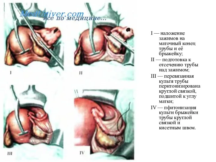 I — наложение зажимов на маточный конец трубы и её