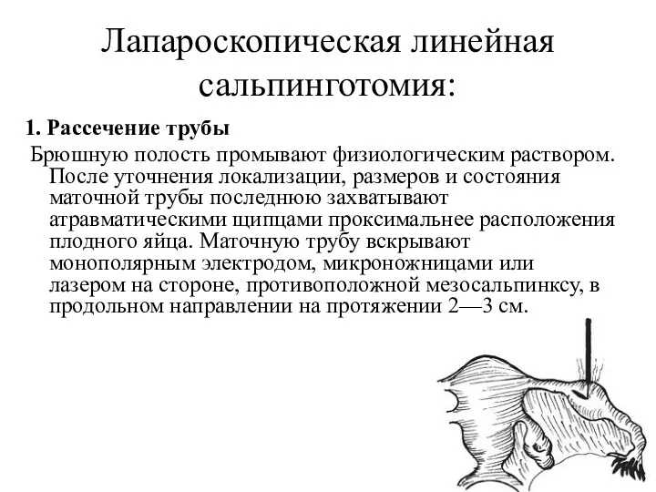 Лапароскопическая линейная сальпинготомия: 1. Рассечение трубы Брюшную полость промывают физиологическим