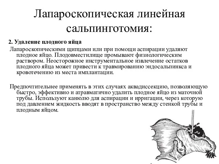 Лапароскопическая линейная сальпинготомия: 2. Удаление плодного яйца Лапароскопическими щипцами или