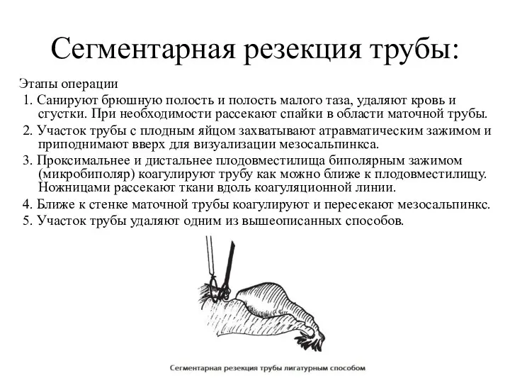 Сегментарная резекция трубы: Этапы операции 1. Санируют брюшную полость и