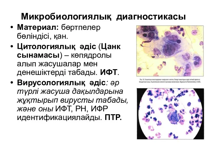 Микробиологиялық диагностикасы Материал: бөртпелер бөліндісі, қан. Цитологиялық әдіс (Цанк сынамасы)