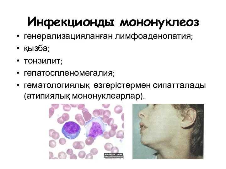 Инфекционды мононуклеоз генерализацияланған лимфоаденопатия; қызба; тонзилит; гепатоспленомегалия; гематологиялық өзгерістермен сипатталады (атипиялық мононуклеарлар).