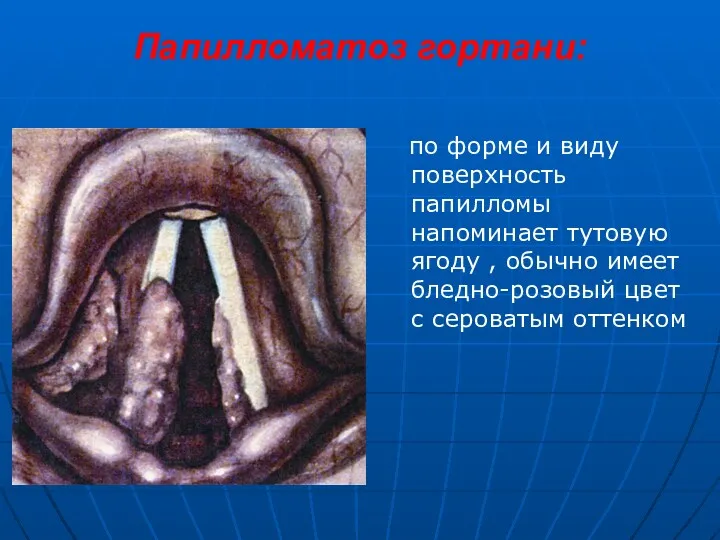 Папилломатоз гортани: по форме и виду поверхность папилломы напоминает тутовую