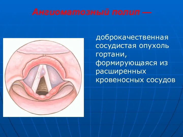 Ангиоматозный полип — доброкачественная сосудистая опухоль гортани, формирующаяся из расширенных кровеносных сосудов